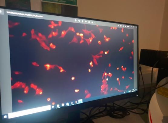 Cancer cells shown on a screen Cancer cells shown on a screen