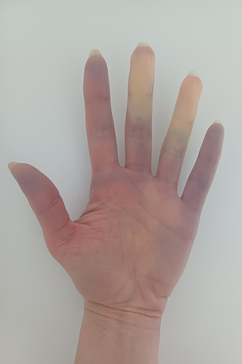 Colour changes to a hand due to Raynaud’s Colour changes to a hand due to Raynaud’s