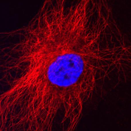 A cancer cell stained with a red dye